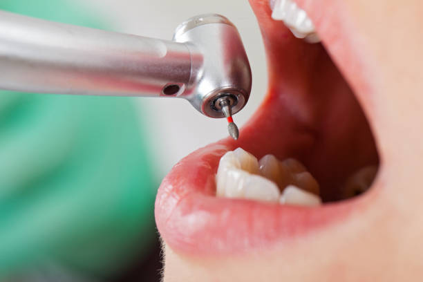 Best Emergency Tooth Extraction in Woodville, FL
